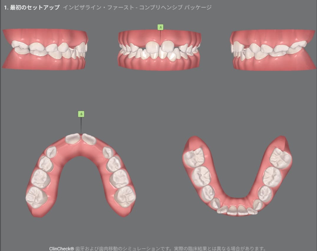 症例8:治療計画シミュレーション・1枚目