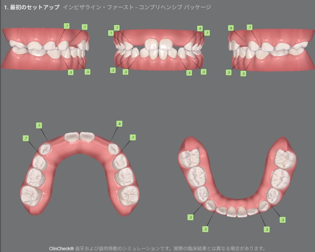 症例8:治療計画シミュレーション・2枚目