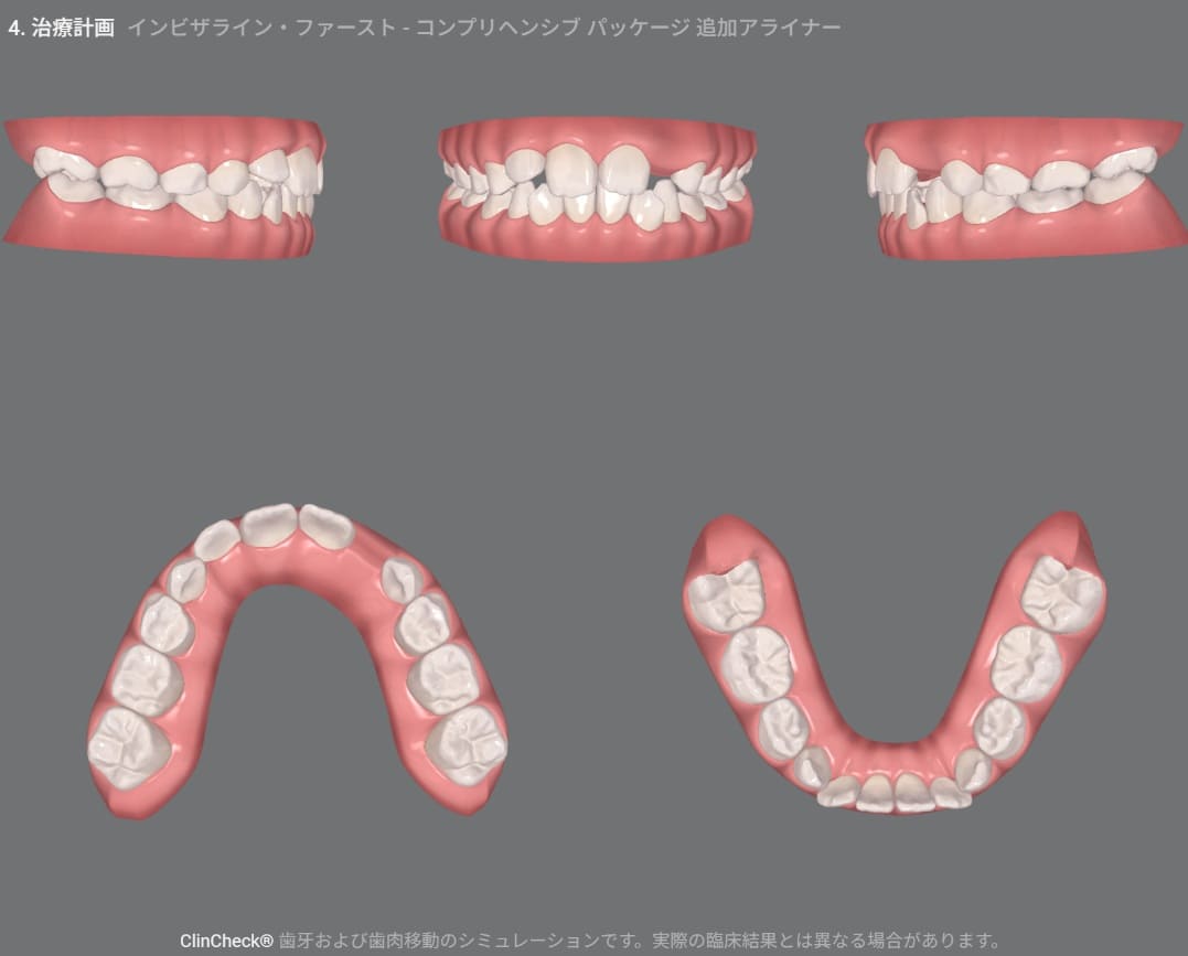 症例8:治療計画シミュレーション・3枚目