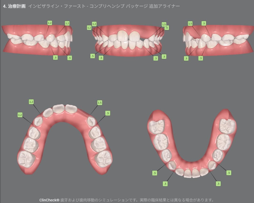 症例8:治療計画シミュレーション・4枚目