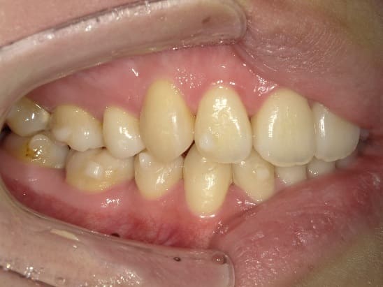症例10:治療中の側方面①写真