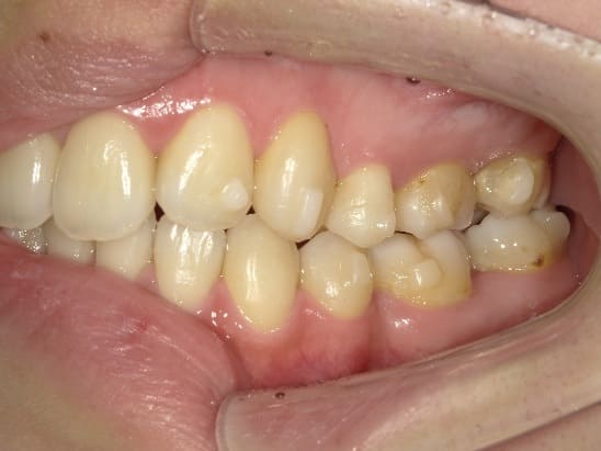 症例10:治療中の側方面②写真